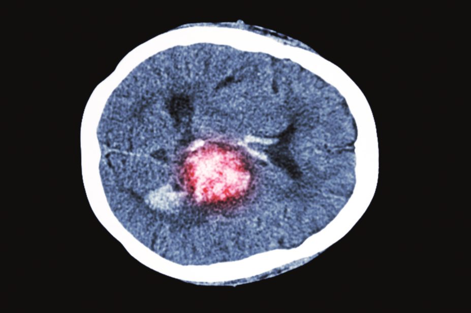 COX-2 inhibitors linked to worse outcomes after ischaemic stroke (pictured)