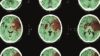 CT brain scan of person who has suffered from ischaemic stroke