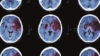 MRI scan of brain suffering from ischaemic stroke