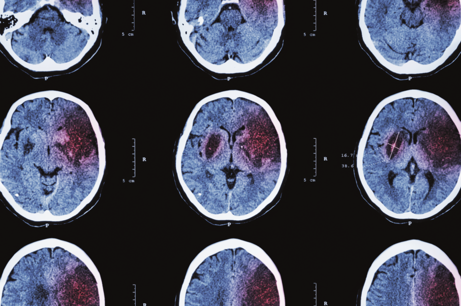 MRI scan of brain suffering from ischaemic stroke