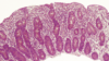 Micrograph of the jejunum affected by coeliac disease