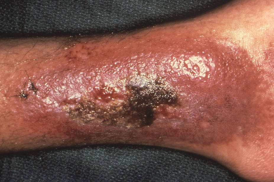 In 2008, the study shows that 40% of new cancer cases among HIV-positive patients were due to infection. The majority were due to infection by Kaposi sarcoma herpes virus (pictured), Epstein-Barr virus and human papillomavirus.