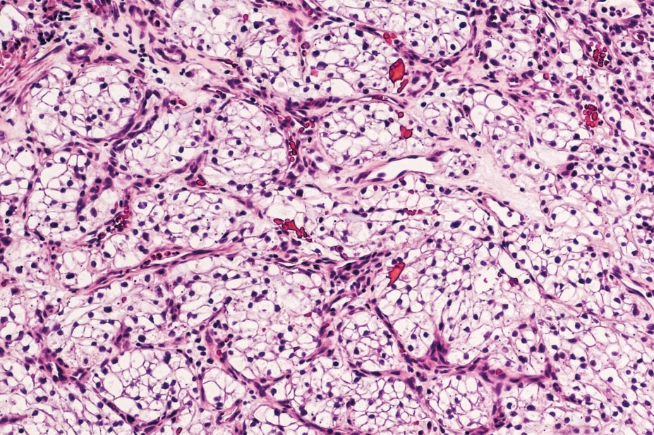 Micrograph of kidney cancer cells
