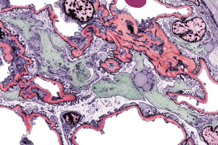 Increasing evidence has linked proton pump inhibitors (PPIs) with acute kidney injury and nephritis. In the image, light micrograph of a section of a kidney with kidney disease