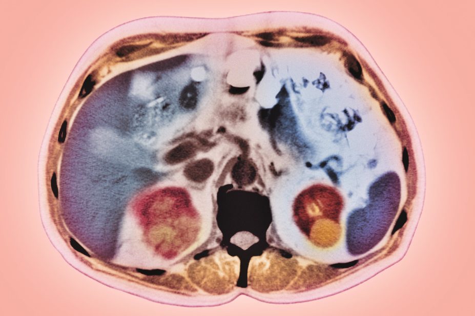 Everolimus has been made available to treat patients in Wales with certain types of renal, pancreatic or breast cancers, or non-cancerous brain or kidney tumours associated with tuberous sclerosis complex. In the image, CT scan of a kidney tumour