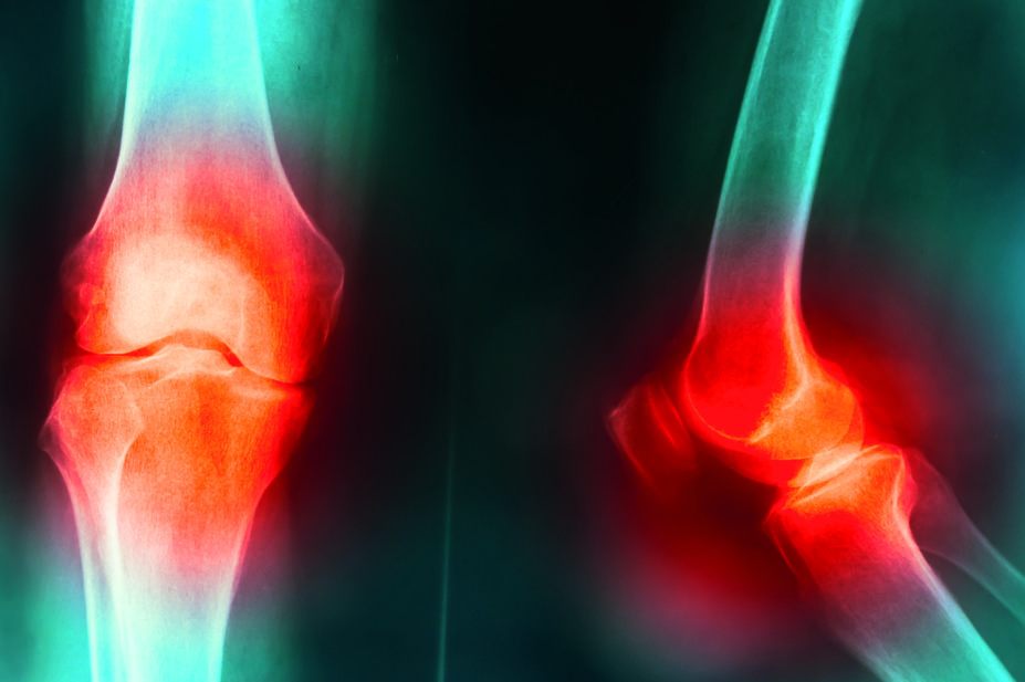 Xray showing knee osteoarthritis