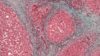 High magnification micrograph of liver cirrhosis
