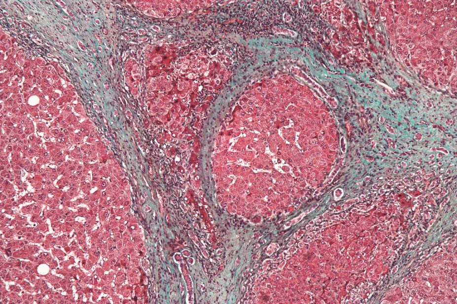 High magnification micrograph of liver cirrhosis