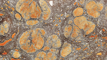 Liver cirrhosis micrograph