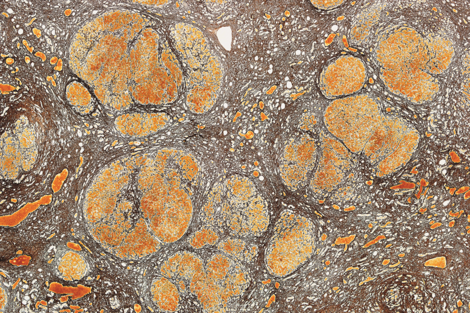 Liver cirrhosis micrograph