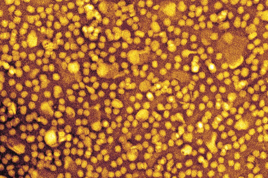 Metformin, one of the most widely used medications for type 2 diabetes, seems to have a positive effect on LDL cholesterol (micrograph pictured) as well as blood glucose, research finds