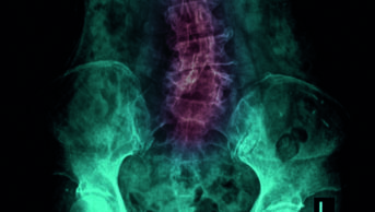 Xray showing spine with lower back pain