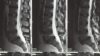 Oral steroids provide a modest boost to function for patients with sciatica. In the image, an MRI scan of a patient with a lumbar herniated disk.