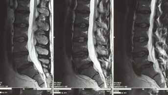 Oral steroids provide a modest boost to function for patients with sciatica. In the image, an MRI scan of a patient with a lumbar herniated disk.