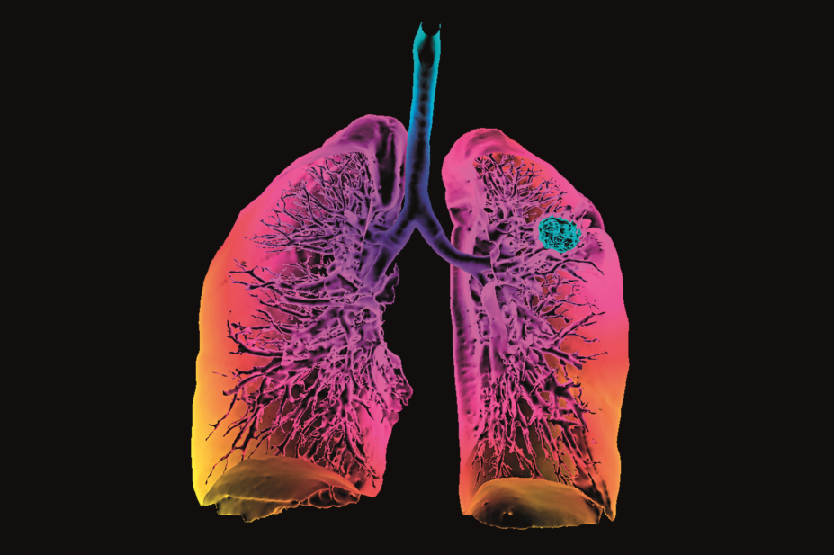 3D CT scan showing lung cancer
