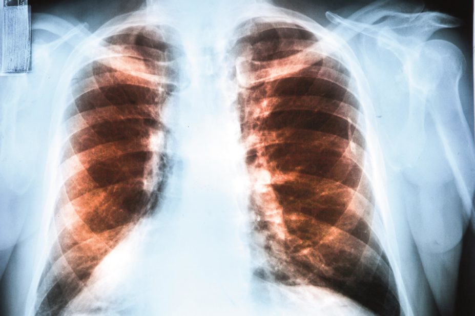Lung cancer patients who have used statins in the year leading up to, or after, a lung cancer diagnosis have a lower risk of death from the disease. In the image, X-ray of a patient with lung cancer