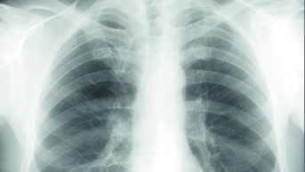 X-ray of lungs with cystic fibrosis