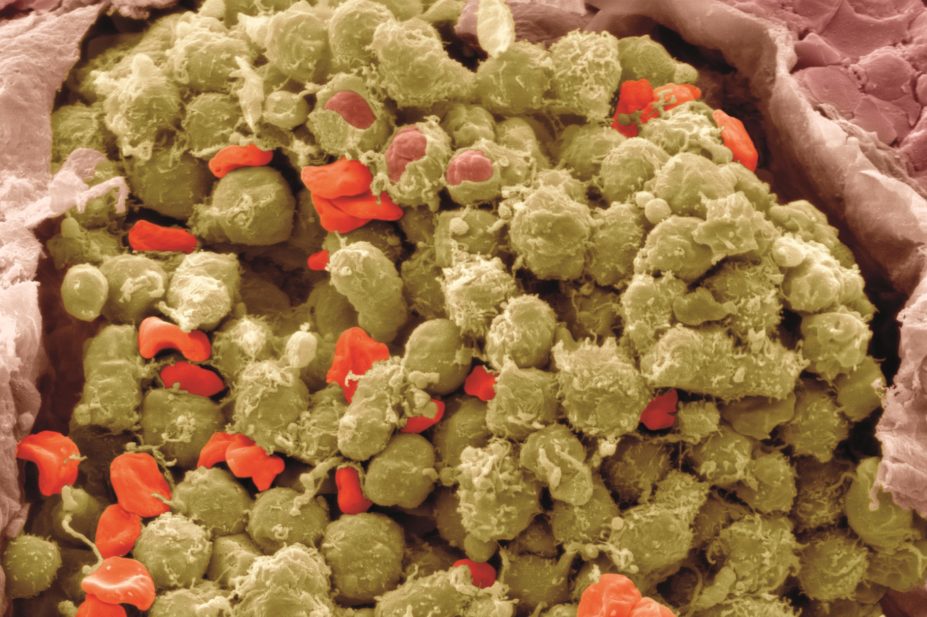 Coloured micrograph of lymphoma cancer cells in a lymph node