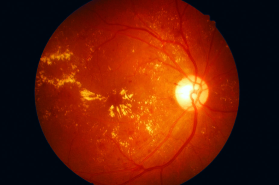 Close-up photograph of retina with macular degeneration