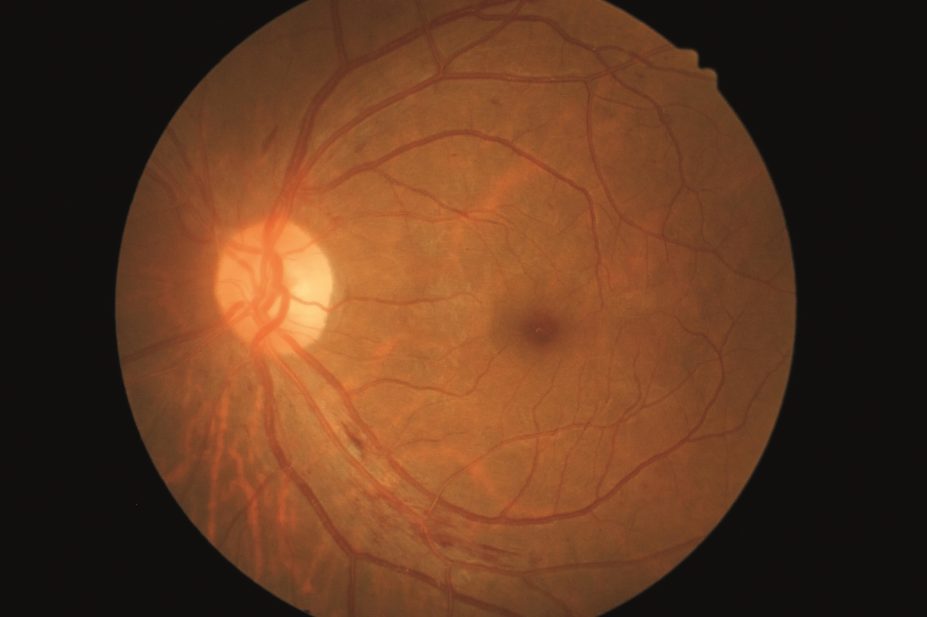 Nucleoside reverse transcriptase inhibitors (NRTIs) which blocks retroviral replication in people infected with HIV, could be used to halt macular degeneration (pictured), research finds