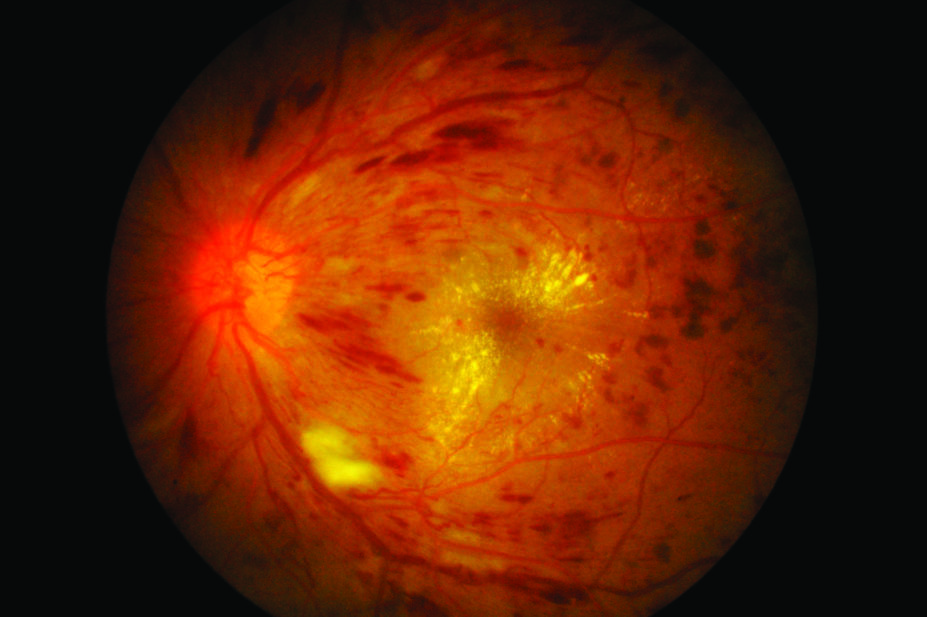 Retinal image showing macular oedema