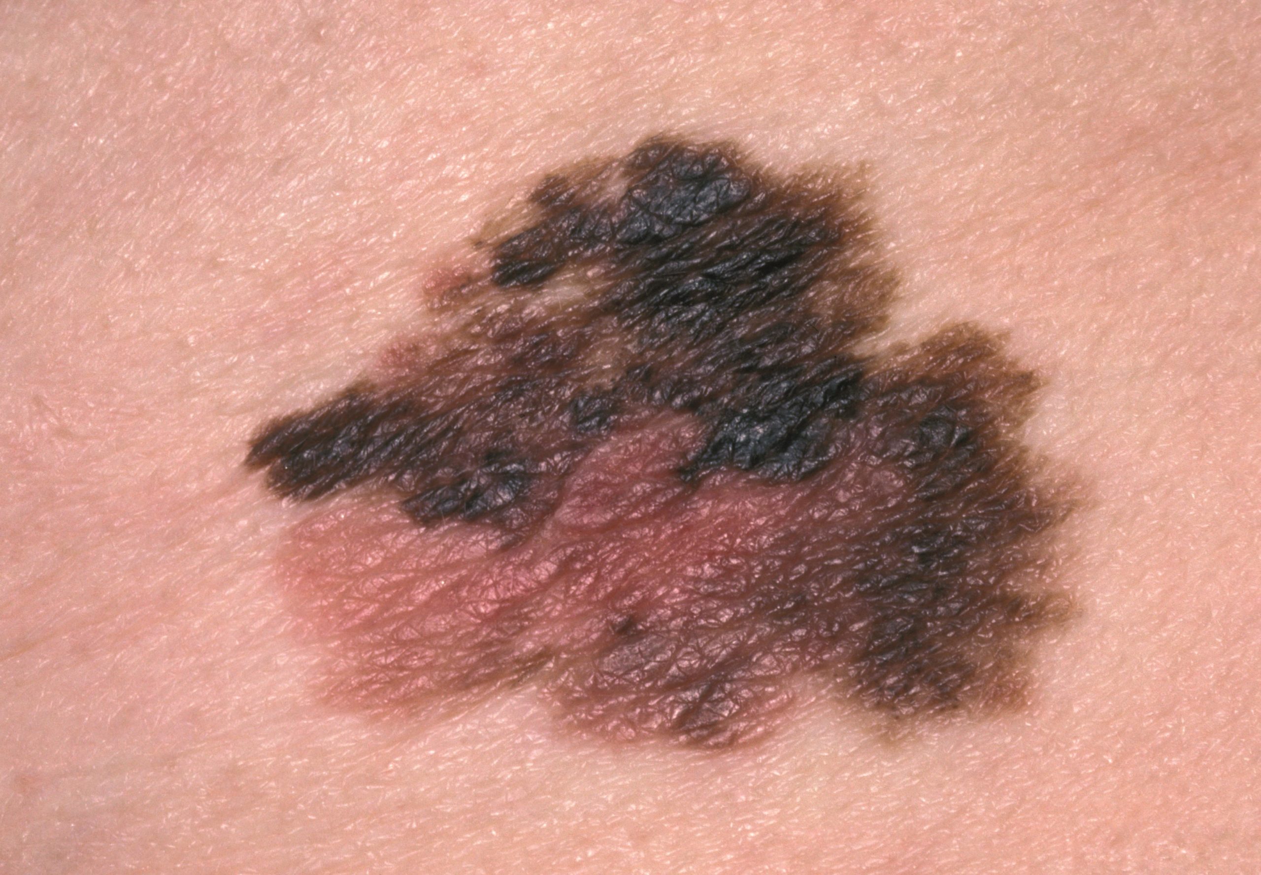 Combination Immunotherapy For Advanced Melanoma Gets Early Approval From Nice The