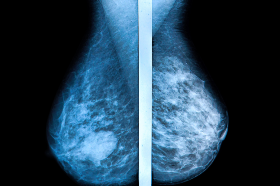 mammogram breast cancer 16