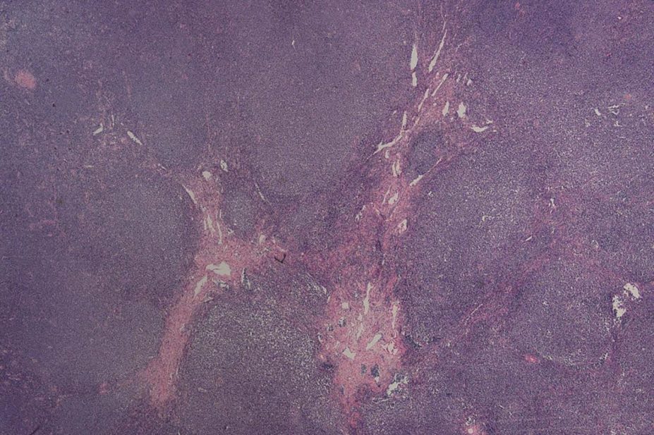 Image of a lymph node with mantle cell lymphoma, which can be treated with Ibrutinib, a Bruton’s tyrosine kinase inhibitor