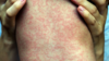 Photo of a child with a measles rash