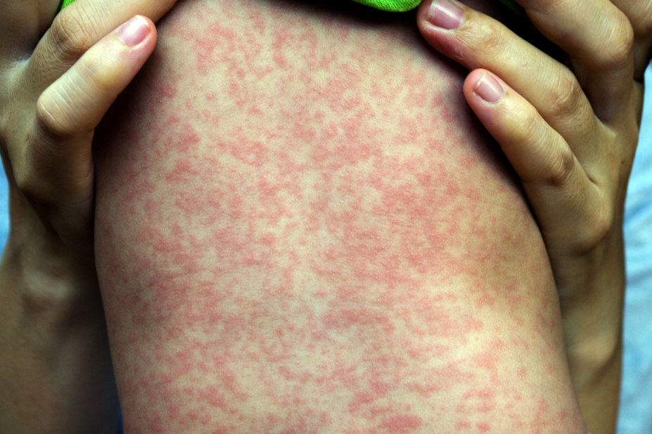 Photo of a child with a measles rash