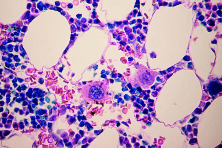 megakaryocytes bone marrow cell in the blood