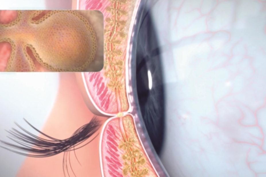 Illustration showing the meibomian gland of the eye