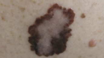 Close up of a melanoma