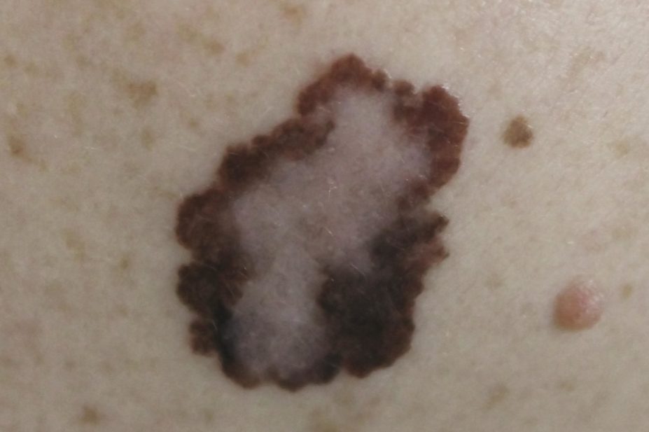 Close up of a melanoma