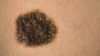 The National Institute for Health and Care Excellence (NICE) is recommending in draft guidance that pembrolizumab (Keyruda) be made available on the NHS for the treatment of some patients with advanced melanoma (pictured)
