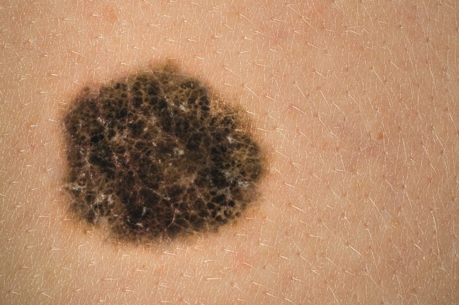 The National Institute for Health and Care Excellence (NICE) is recommending in draft guidance that pembrolizumab (Keyruda) be made available on the NHS for the treatment of some patients with advanced melanoma (pictured)