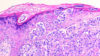 Micrograph of melanoma