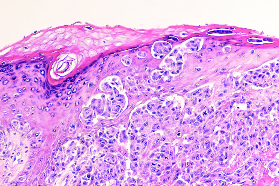 Micrograph of melanoma
