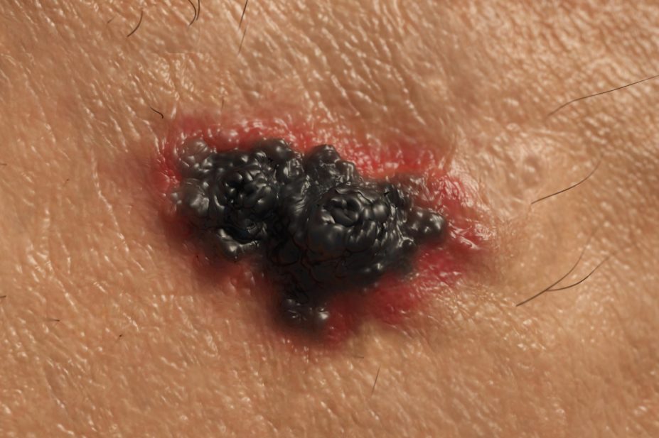 A close up of melanoma