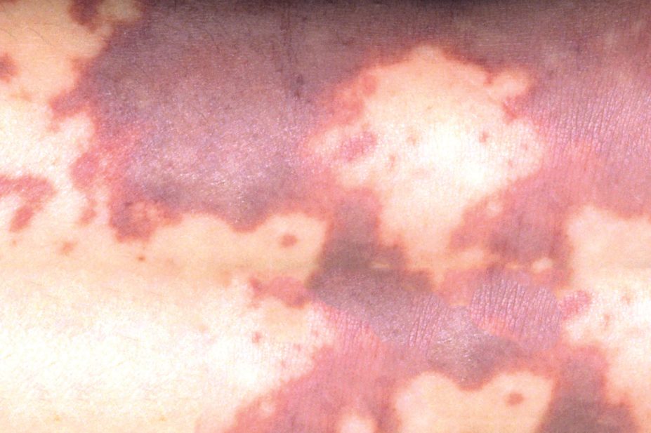 Close up of meningococcal septicaemia rash