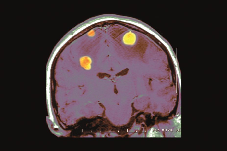 MRI of metastasis in the brain