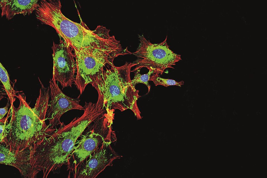 Researchers find immune system involved in metastasis-boosting microenvironment in mice. In the image, metastatic breast cancer cells.