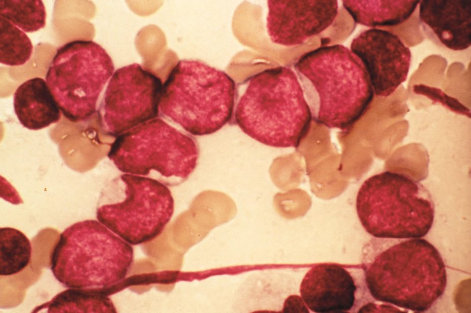 Micrograph of acute myeloid leukaemia (AML)