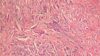 Micrograph of breast cancer cells