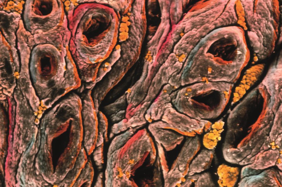 As more people are being diagnosed with coeliac disease, the first drug treatments are entering clinical trials; but success is proving difficult to measure. In the image, micrograph of an intestine with coeliac's disease