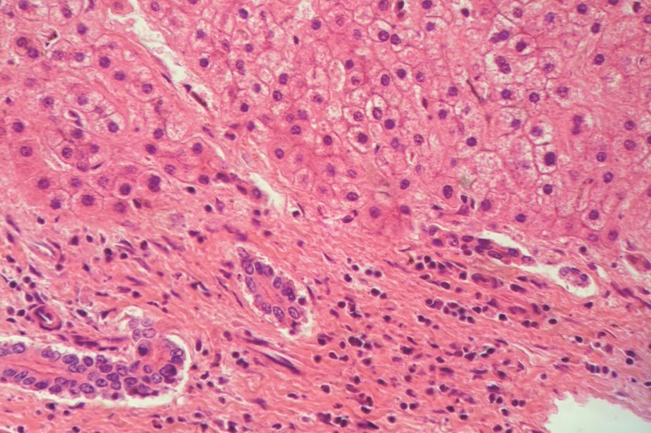 Micrograph of a liver with hepatitis C