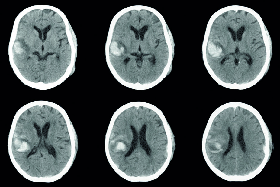 MRI scan showing intracranial haemorrhage