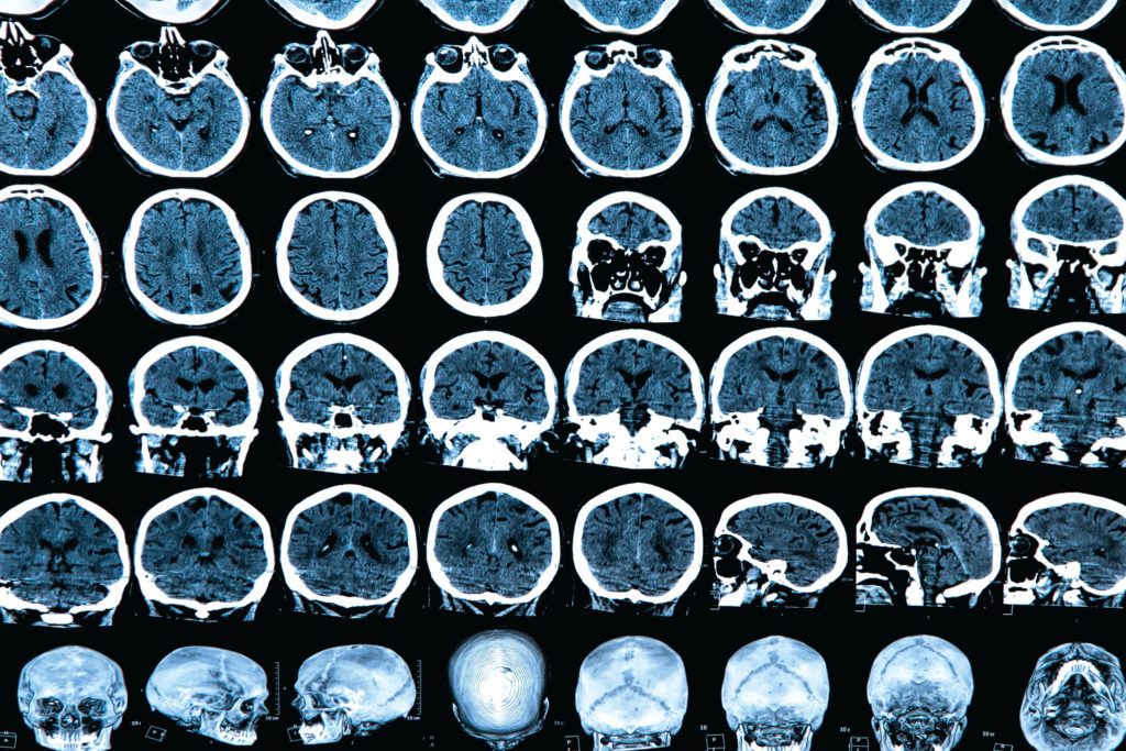 Brain scans could match patients to best depression treatment - The ...