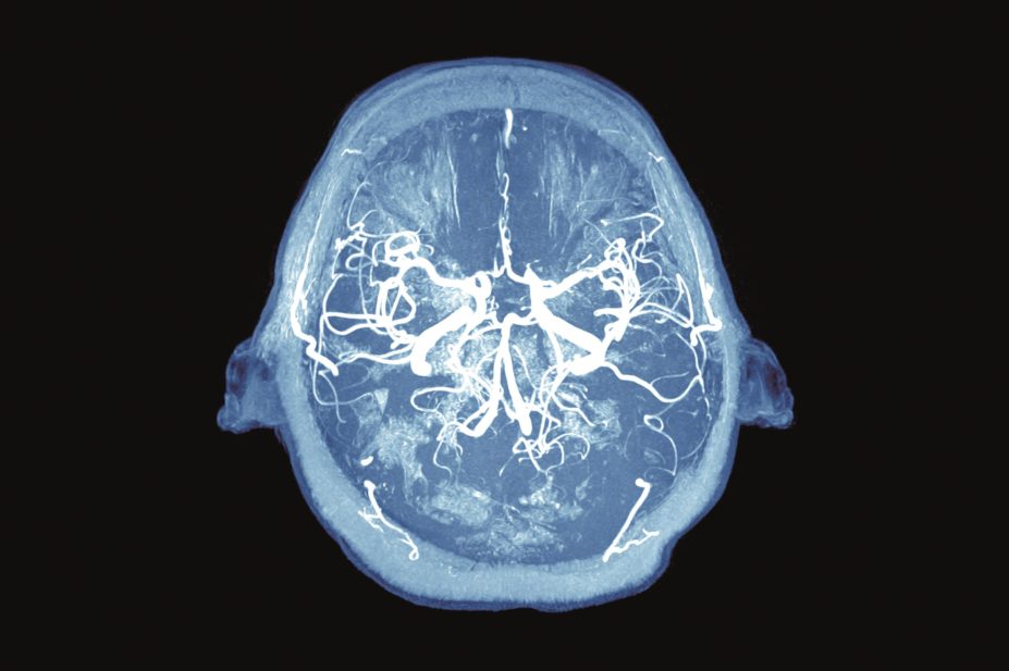 Patients who take glitazone drugs to manage their diabetes may have some protection from developing Parkinson’s disease, suggests research. In the image, an MRI scan of a patient's brain