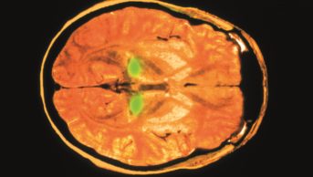 MRI brain scan of brain with Creutzfeldt-Jakob disease.